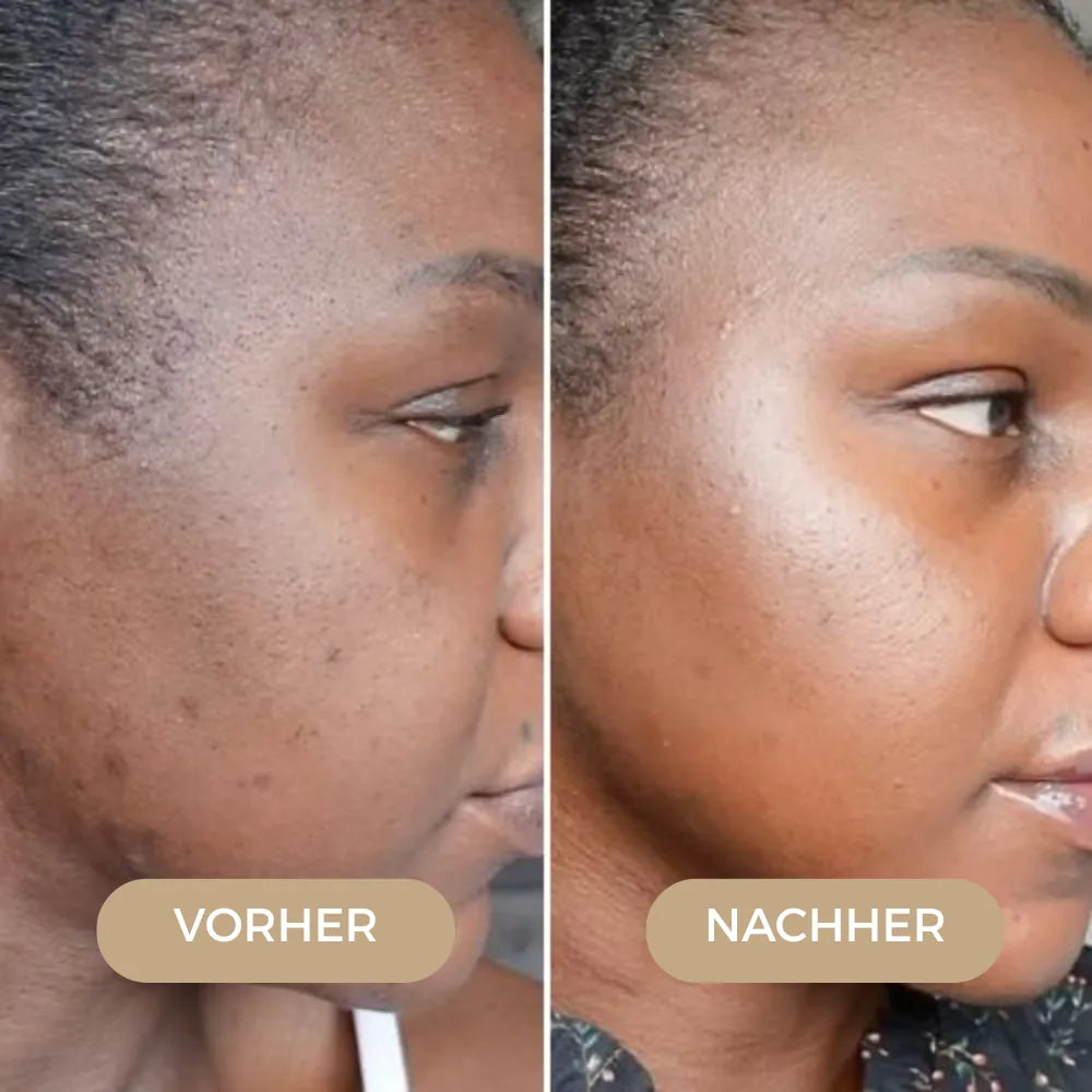 Luméra - LED Lichttherapie Gesichtsmaske