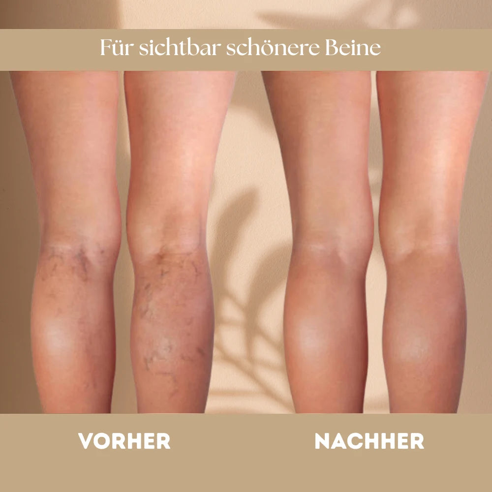 Revora - Krampfadern einfach lindern