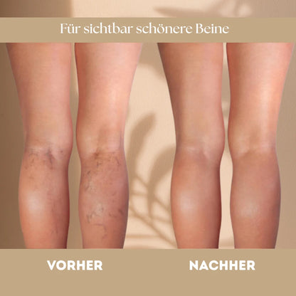 Revora - Krampfadern einfach lindern